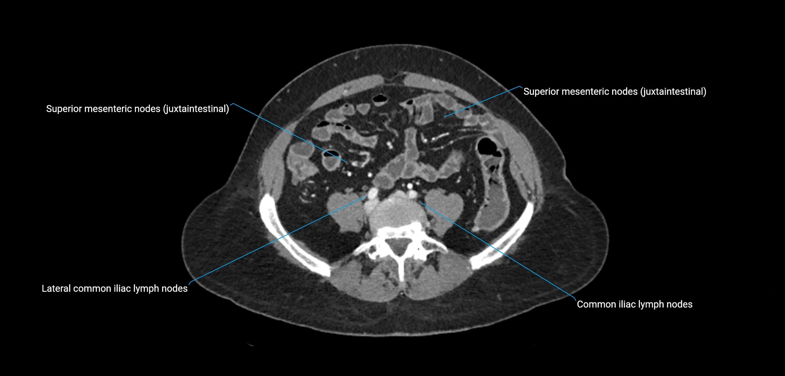 CT ct abdominal lymph nodes  axial cross sectional anatomy  enchanced radiology image -img-00002-00289.webp